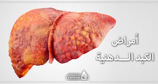مرض الكبد الدهني
