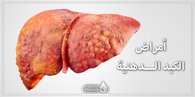 مرض الكبد الدهني