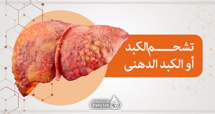 تشحم الكبد أو الكبد الدهني