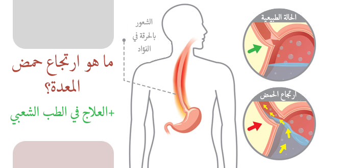 كيف يتم علاج ارتجاع حمض المعدة في الطب الشعبي المقدم فی طب