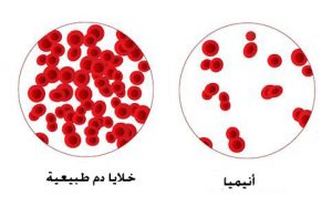 فقر الدم الناتج عن نقص الحديد