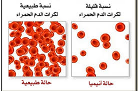 ما هو فقر الدم؟