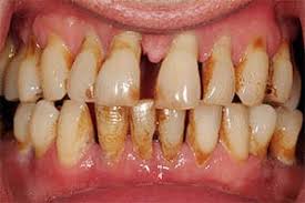 أسباب البخر الفموي-مشاكل الأسنان