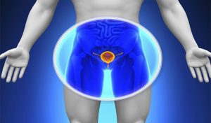 سرطان البروستاتا- سرطان البروستاتا سرطان شائع في الرجال