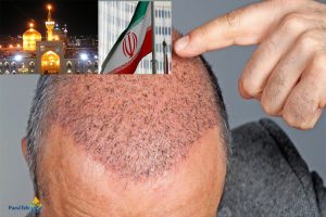 زراعة الشعر في إيران-تكاليف زراعة الشعر في إيران 