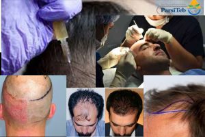 زراعة الشعر-مراحل عملية زراعة الشعر