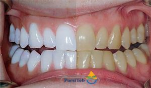 تبييض الأسنان-أسباب تغيير لون الأسنان 