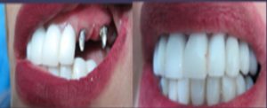 محاسن زراعة الأسنان-قبل وبعد عملية زراعة الأسنان 