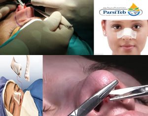 عملية جراحة تجميل الأنف-مراحل عملية جراحة الأنف-مراحل عملية تجميل الأنف