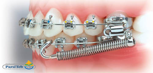 آلية تقويم الأسنان