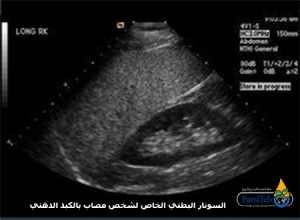 الكبد الدهني الدرجة الثانية-السونار البطني الخاص لشخص مصاب بالكبد الدهني
