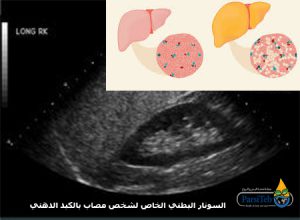 الكبد الدهني -السونار البطني للكبد الدهني
