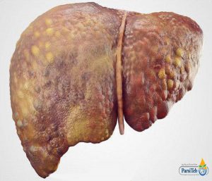 الكبد الدهني في مراحله المتقدمة