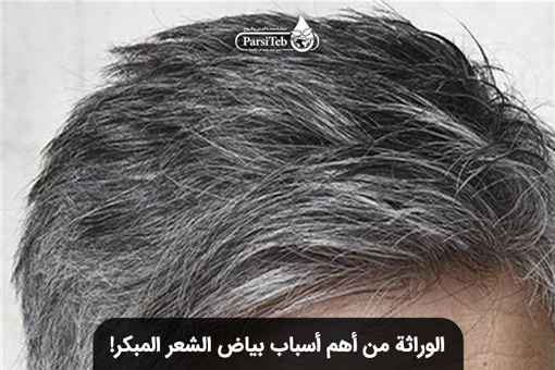 الوراثة وبياض الشعر المبكر